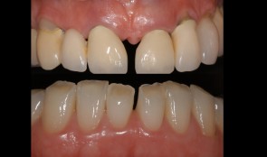 Replacement of maxillary restorations and esthetic rehabilitation