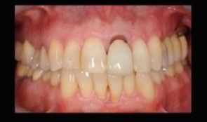 Reinstatement of complete oral health in patient with periodontitis