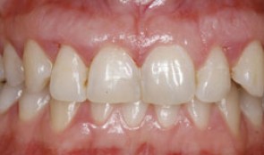 Immediate implant placement after thorough periodontal treatment