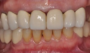 Minimal occlusion with implant-supported cantilever crowns
