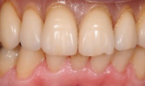 Implants allow palatal-free denture in upper jaw
