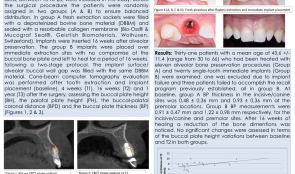 ALVEOLAR DIMENSIONAL VARIATIONS IN ALVEOLAR PRESERVATION AND POST-EXTRACTION IMMEDIATE MAXILLARY IMPLANTS—A 3-D MULTILEVEL MULTIVARIATE PROSPECTIVE STUDY
