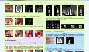 IMMEDIATE FLAPLESS PLACEMENT OF AN IMPLANT IN A MAXILLARY RIGHT FIRST PREMOLAR SITE—CBCT EVALUATION OF FACIAL BONE PRESERVATION USING A NOVEL MODIFIED APPROACH