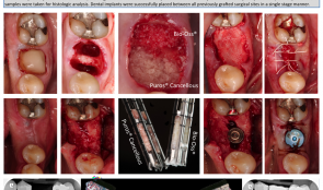 CLINICAL AND HISTOLOGICAL ANALYSIS OF DUAL SOCKET GRAFTING – A PILOT STUDY