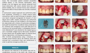 GUIDED BONE REGENERATION (GBR) IN THE AESTHETIC ZONE—RESTORATION OF HORIZONTAL BONE DEFECTS WITH MIXED BONE GRAFT AND TITANIUM MESH