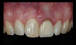 Aesthetic upper anterior implant placement case