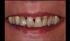 An esthetic rehabilitation of periodontally damaged teeth
