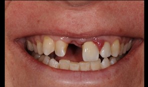 Anterior esthetic case