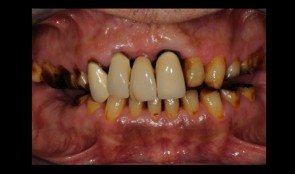 Comprehensive prosthetic treatment