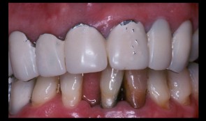 Comprehensive treatment of periodontitis with full mouth reconstruction