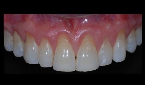 Connective tissue graft with tunnel technique for root coverage