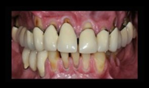Esthetic and functional dental rehabilitation