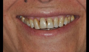 Esthetic improvement in case with generalized gingival recessions