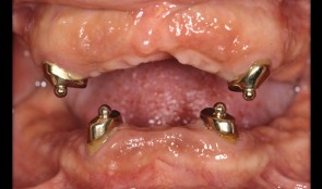 Esthetic improvement in implant-supported fixed and removable dentures
