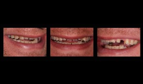 Esthetic rehabilitation in patient with myoarthropathy
