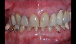 Fixed reconstructions in upper and lower jaw