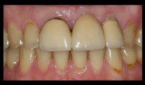 Fixed reconstructions on teeth and implants treating erosions
