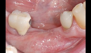 Free gingival graft and abutment connection surgery