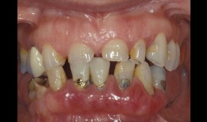 Full reconstruction of lower jaw inculding esthetic improvement
