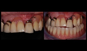 Implants for patient with Sjögren-Syndrome and bisphosphonate medication