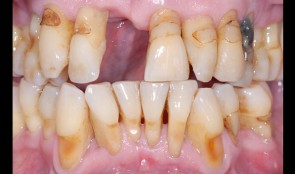 Missing central incisor in addition to severe chronic periodontitis