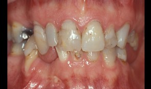 Multiple missing teeth and caries