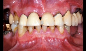 Old reconstructions and missing teeth - a comprehensive case