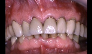 Patient referred has reconstruction in maxilla, shortened dental arch reconstructed