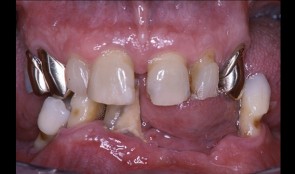 Periodontitis case, fixed reconstructions on implants (bridge and single crown)
