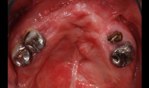 Reconstruction of the edentulous upper jaw of cleft patient