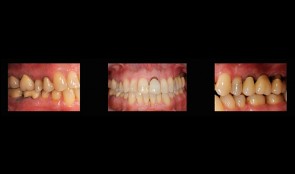 Rehabilitation of masticatory performance in a patient with periodontitis