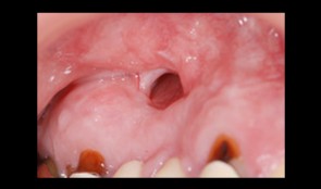 Total reconstruction after closure of maxillary sinus fistula