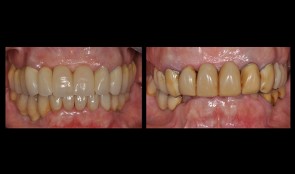 Unesthetic reconstructions - a challenging case
