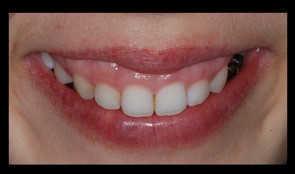 Upper anterior esthetic crown lengthening