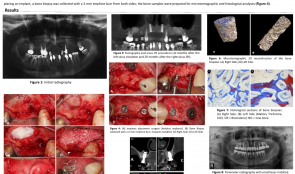 BONE FORMATION AT 12 MONTHS AND 20 MONTHS AFTER SINUS ELEVATION SURGERY WITH INORGANIC BOVINE BONE—A SPLIT-MOUTH CASE REPORT WITH MICROTOMOGRAPHIC AND HISTOLOGICAL EVALUATION
