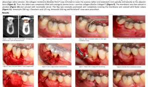 MANDIBULAR CLASS II FURCATION REGENERATION USING A COLLAGEN MEMBRANE ASSOCIATED WITH ANORGANIC BOVINE BONE PLUS PORCINE COLLAGEN—A CASE REPORT WITH TOMOGRAPHIC EVALUATION