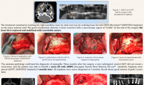 BONE LID APPROACH FOR TREATMENT OF ASPERGILLUS IN MAXILLARY SINUS BEFORE SINUS FLOOR ELEVATION—A CASE REPORT
