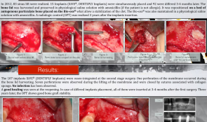 BONE LID FOR CLOSING MAXILLARY SINUS WINDOW DURING SINUS GRAFTING WITH ANORGANIC BOVINE BONE MINERAL (ABBM) AND AMOXICILLIN—3-YEAR FOLLOW-UP OF 83 CASES