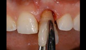 Alveolar ridge preservation