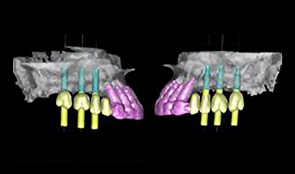 Implant planning