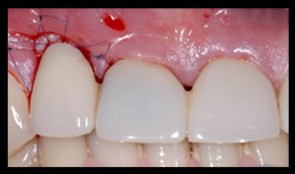 Pre- and peri-operative soft tissue management