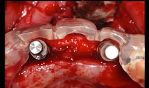 Implant surgery