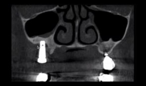 Sinus floor elevation