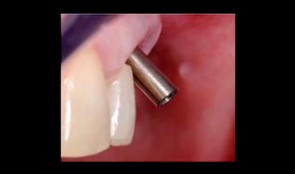 Postoperative Care and Complications