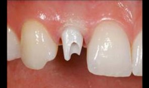 Choice of abutment