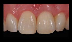 Prosthetics: Single crowns