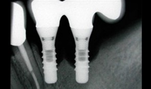 Biologic Complications - Peri-implantitis