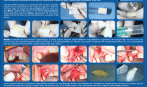 ACHIEVING A MORE EFFICIENT CONTACT SURFACE BETWEEN A BLOCK BONE AND RECIPIENT AREA USING A 3D STEREOLITHOGRAPHY (SLA) MODEL OF A JAW FRAGMENT IN ADJUSTING A HUMAN BONE BLOCK TO THE RESIPIENT AREA AND  TIME SAVING DURING OPERATION