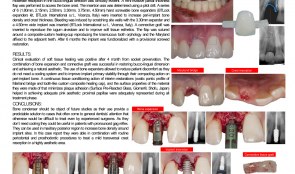 BONE EXPANSION WITH SCREWABLE BONE EXPANDERS IN THE AESTHETIC ZONE – A CASE REPORT