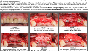 INCREASE OF TRANSVERSE VOLUME USING GUIDED BONE REGENERATION (GBR) WITH ANORGANIC BOVINE BONE MINERAL (ABBM) IN AESTHETIC AREAS AFTER AUTOGENOUS BONE GRAFT—A CASE REPORT